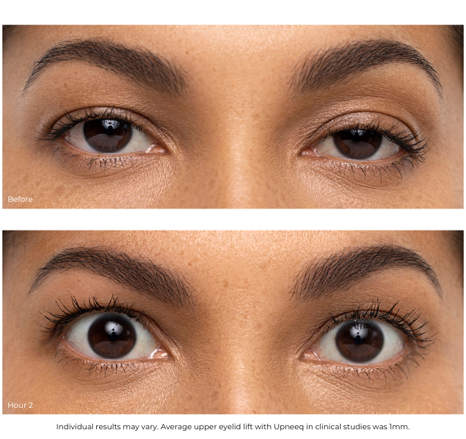 eyedrop